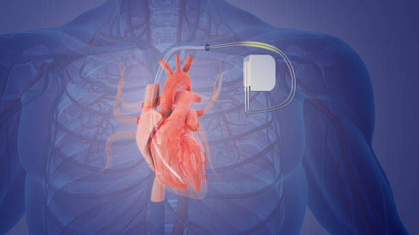 Pacemaker Implantation in Cunningham Road