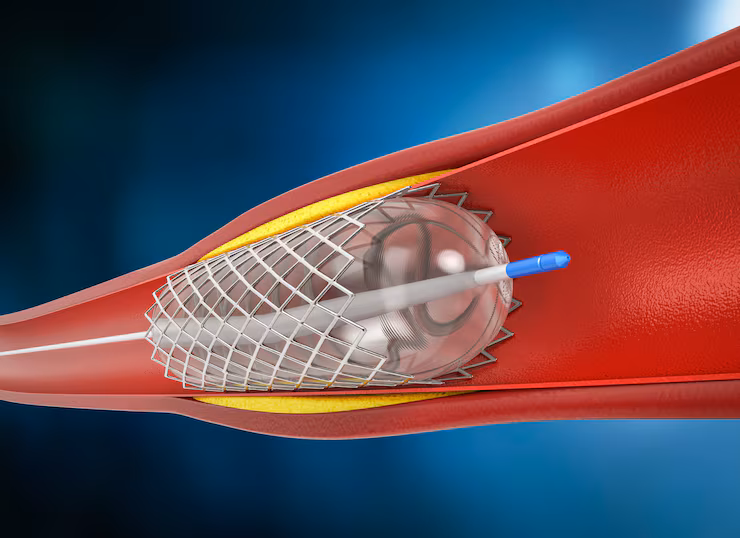 Trusted Angioplasty Procedure in Vasanth Nagar